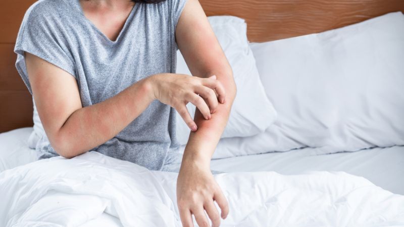 What Can Bed Bug Bites Be Confused With?